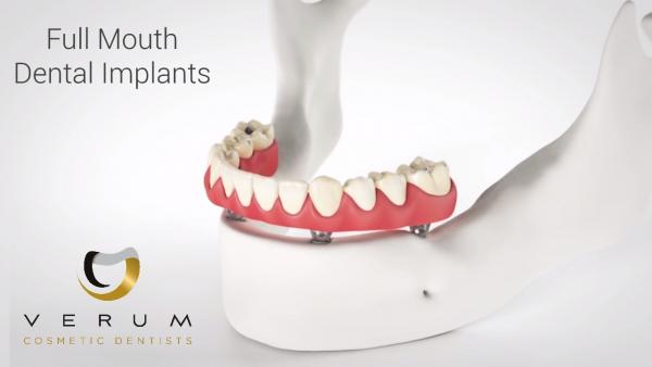 Coventry Dental Implants