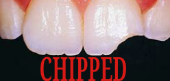 get dental crown treatment for chipped amp damaged teeth with this marietta ga s