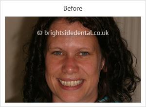 bounds green restorative dentistry announces affordable invisalign treatment ope