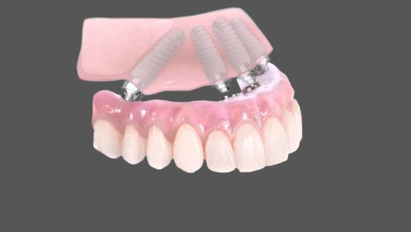 dental center glyfada offers all on4 implant procedure teeth in 1 day