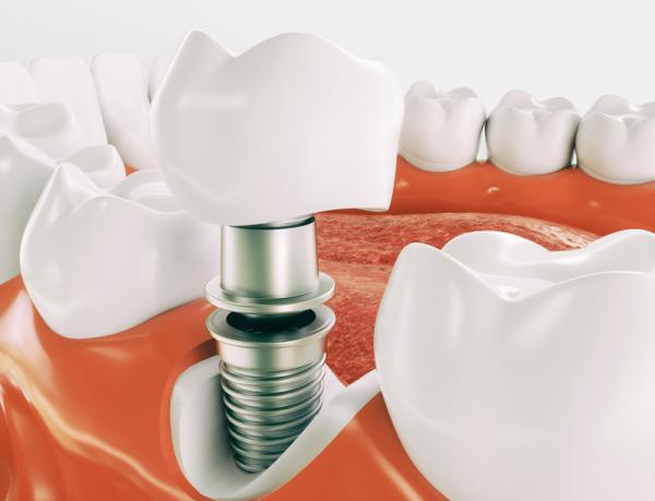 get the best kennewick dental implants amp crowns expert tooth replacement