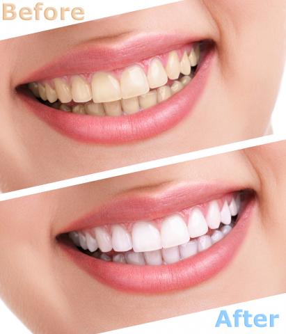 get the best waukesha new berlin tooth whitening services expert cosmetic dentis