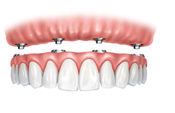 get the most affordable dental implant services for patients in glyfanda