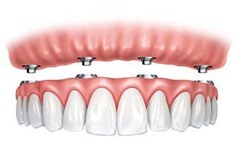 teeth in one day with all on 4 implant protocol