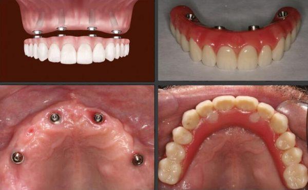 teeth in one day with all on 4 implant protocol