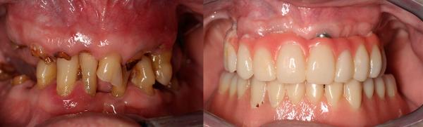 teeth in one day with all on 4 implant protocol