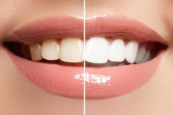 teeth whitening las vegas using kr system changes smiles and embellish lives