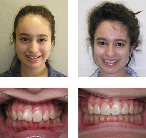 braces las vegas are no longer the best choices for 90 of patients