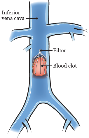 ivc blood clot filter mass tort lawsuit get paid for suffering or referrals