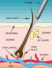 get the best palm beach permanent hair removal at this electrolysis clinic