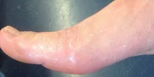 get rid of excessive sweating with this amazing medically approved device