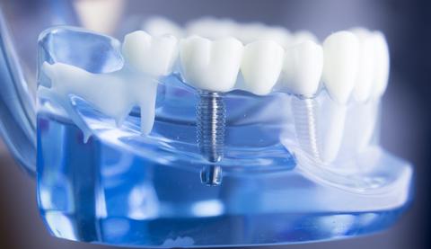 get the best dental implant permanent solution for missing teeth in sterling va