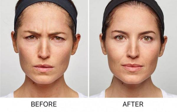 get the best sacramento anti wrinkle facials amp dermal fillers to look younger