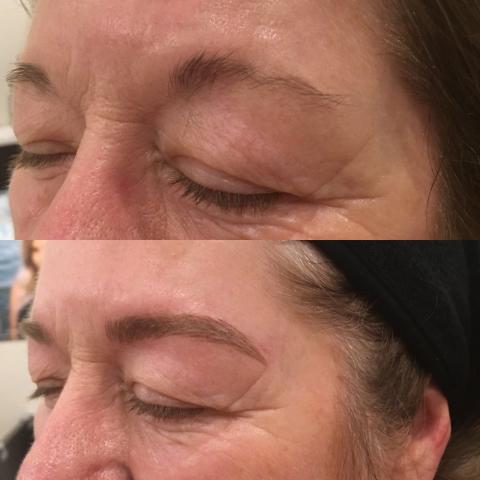 get the best sacramento anti wrinkle facials amp dermal fillers to look younger