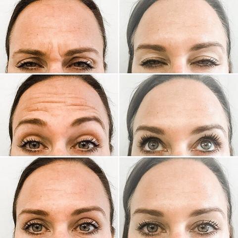 get the best sacramento anti wrinkle facials amp dermal fillers to look younger