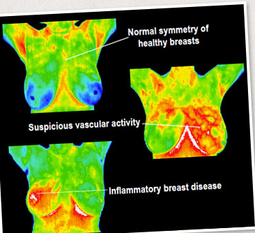 Get The Best Thermal Imaging Trusted Breast Screening Service In St Louis Park
