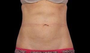 lose weight quickly and painlessly from any part you wish with coolsculpting