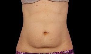 lose weight quickly and painlessly from any part you wish with coolsculpting