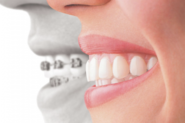 get the best invisalign consultation and dental treatment in mt eden auckland