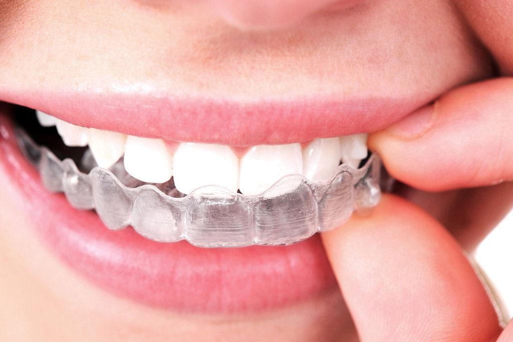 A Clear Choice: Invisalign for Fixing Crowded Teeth and Gaps